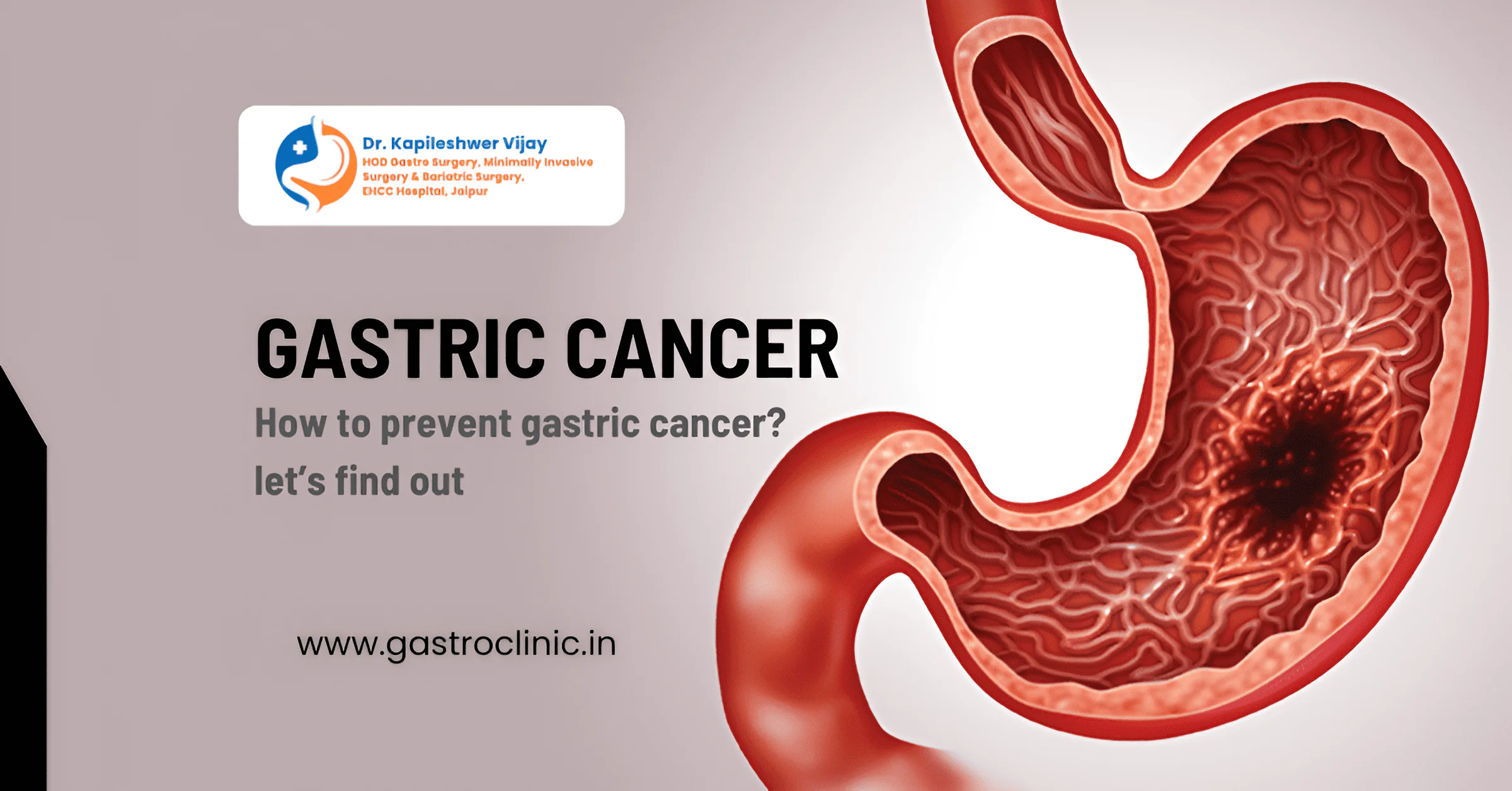Why is gastric cancer increasing in India? Know the prevention